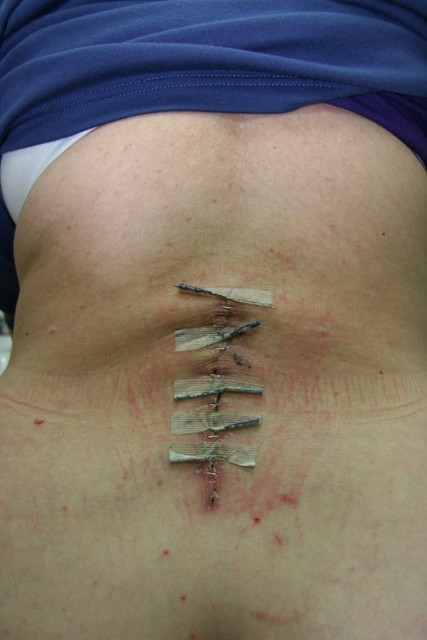 Rosemary's lumbar spine surgery scar.  December 17th 2006- two weeks after the event.  Note the metal staples keeping it from falling apart.