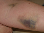 Come on, getting an IV in isn't that hard...